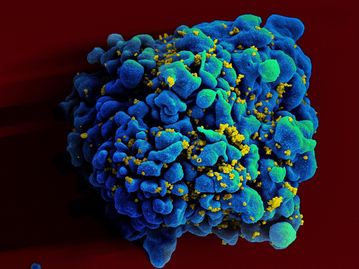 hiv cure thrid patient remission successful