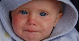 Measles Outbreak 2019: Quick Facts and What You Need to Know about the Disease