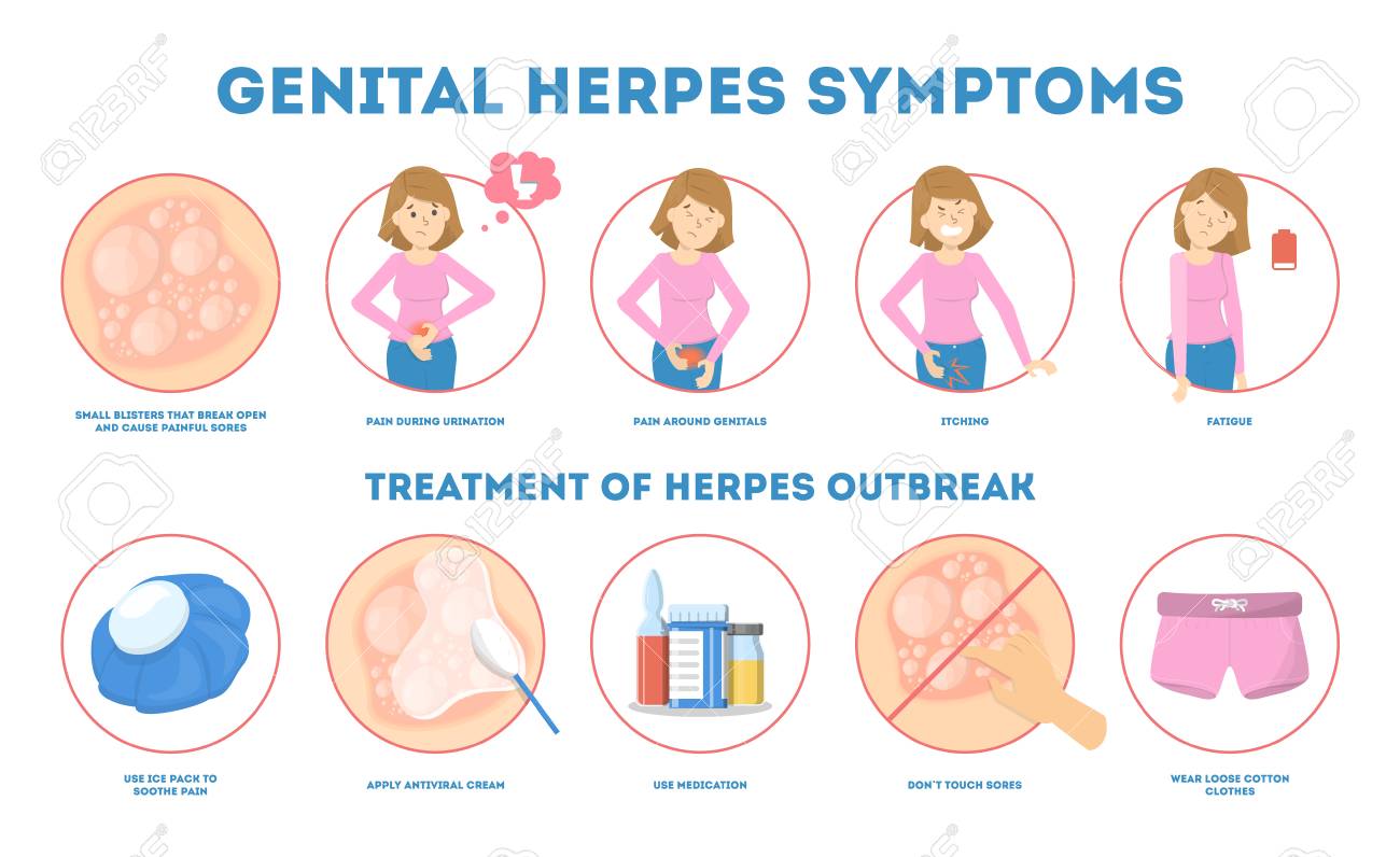 This new cure of Herpes can stop the infection from spreading