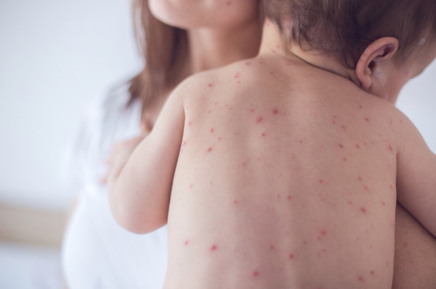 measles outbreak 2019